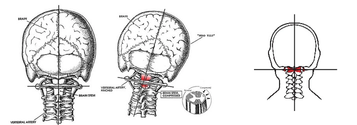 Chiropractic New York NY Upper Cervical Technique